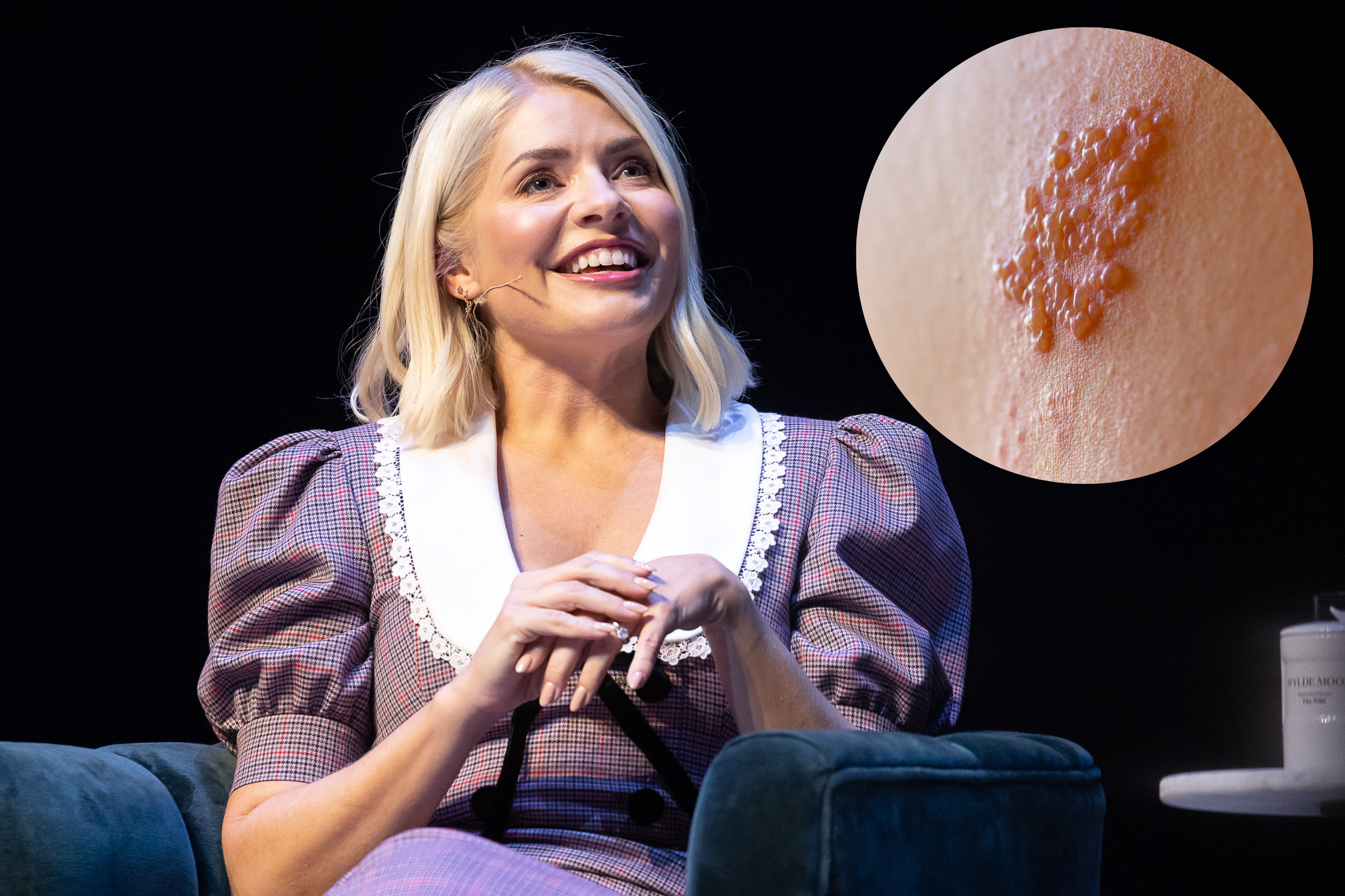 What is shingles? As ITV’s Holly Willoughby suffers illness