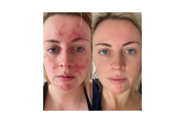 Customers share amazing before and after results of skincare brand that took the world by storm - Abigail's results 47 Skin