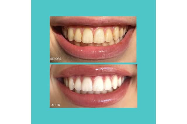 Smilie Before and after