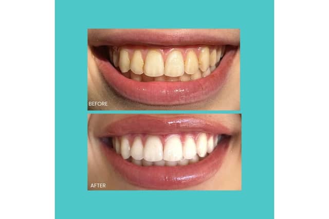 Smilie Before and after
