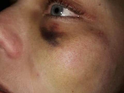 Both her arms and legs were also injured following the attack.