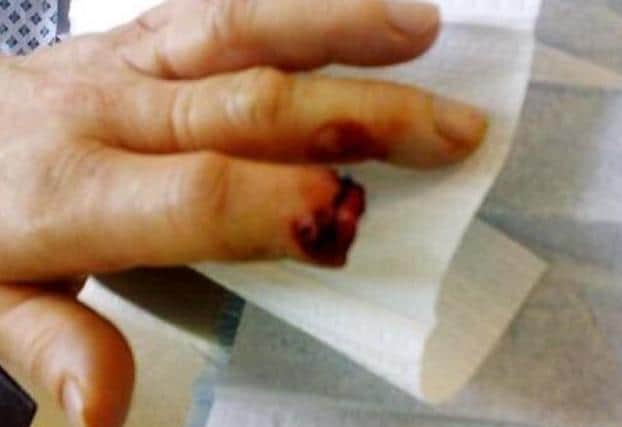 The CWU campaigns to prevent injuries such as this, similar one suffered in Rushden before Christmas. The union wanted to this image published to show the impact of dog attacks on post workers.