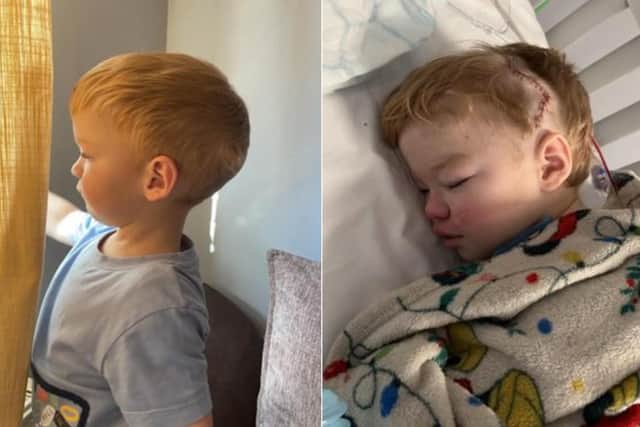 Two-year-old Eli before and after skull surgery.