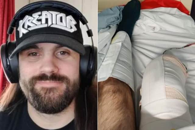 Simon Webb, 32, had to have his lower leg amputated after his Epithelioid Sarcoma returned.