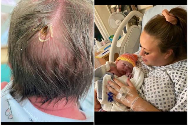Hayley Allen's child Thea Herbert was born with a hole in her head caused by a fetal heart probe