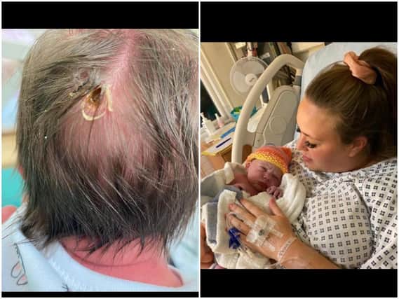 Hayley Allen's child Thea Herbert was born with a hole in her head caused by a fetal heart probe