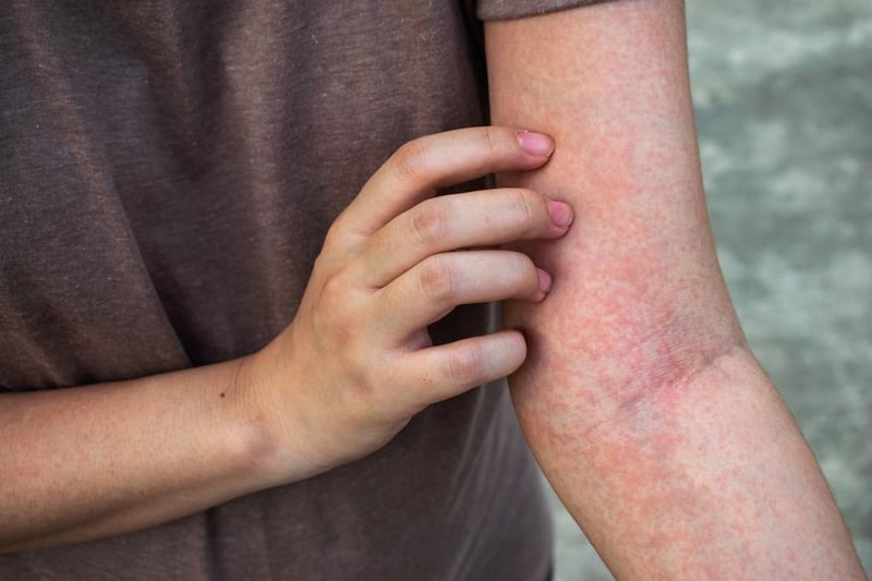 Rashes can also be a common symptom of long Covid