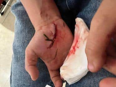 Charlie's injury.