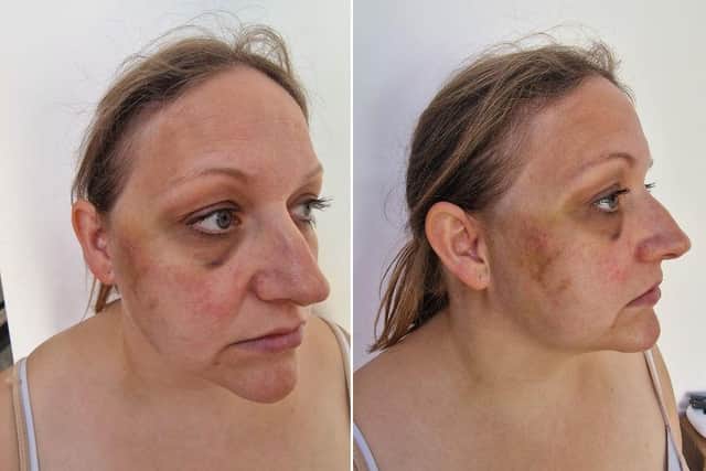 These photos of victim Jessica Lopes were taken a few days after the attack, when the bruising came out on her face.
