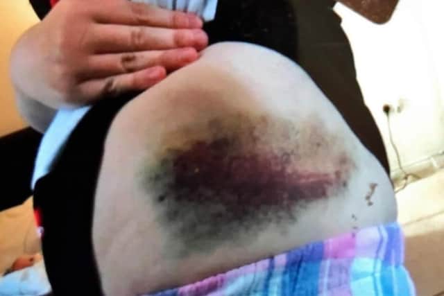 Jessica was often subjected to physical abuse that left her with bruising and other injuries that required hospital treatment.