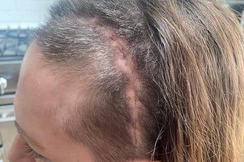 Gemma Hillier and her surgery scar.