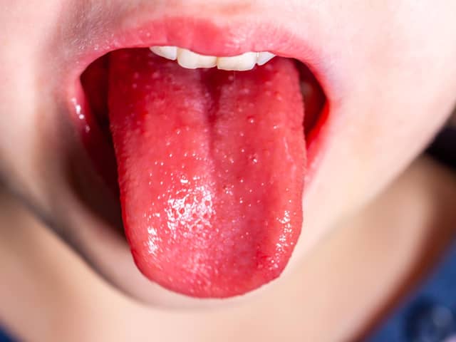 The tongue of a child with scarlet fever. Photo: Lukassek on Adobe.