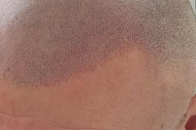 Scalp Micro Pigmentation is reported make a really natural difference