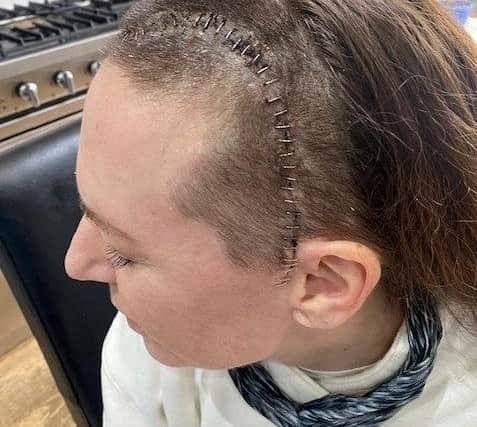 Gemma Hillier and her surgery scar.