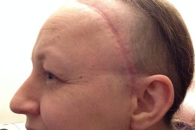 Scar on Catherine's head from brain surgery