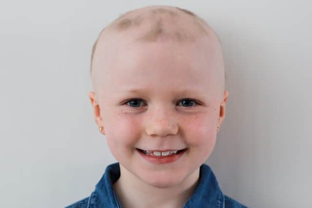 It is estimated that every 15 in 10,000 people in the UK are affected by alopecia and it can present at any age, but 50 percent find it starts in childhood.