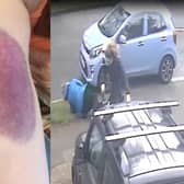 One of Shirley's bruises and the moment she was knocked to the ground