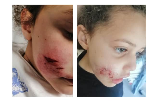 Lola Miller's injured face