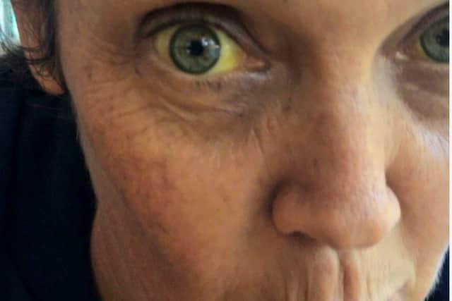 At one stage Gemma suffered from jaundice