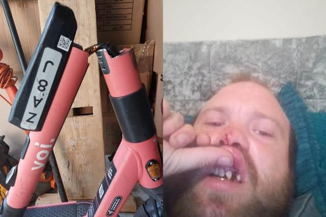 Ashley Potter, from Little Billing, was on the way back from picking his son up from school on in September 2022 at around when his Voi scooter's handlebars “snapped” while crossing a road in Weston Favell. The 30-year-old dad said "As I got into the middle of the road the handle bar snapped. I fell to the floor, smashed my face off the kerb and smashed my teeth. I'm never going to use them again. Never. I think they should take them out of use completely or until Voi finds a stronger way of constructing it." A Voi spokesman confirmed the incident and said it is currently in the process of investigating it. The spokesman said: “Safety is our number one priority, and we take all incidents involving our riders seriously."