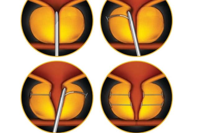 The procedure has been likened to opening curtains on a window by holding back the prostate with implants.