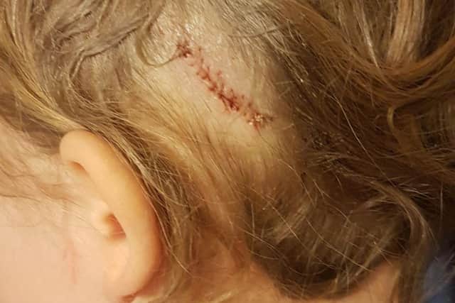 Tiffany MacPherson's wound needed 26 stiches