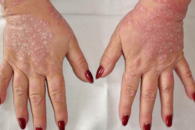 Psoriasis is a common skin condition that causes red and sometimes painful irritation.