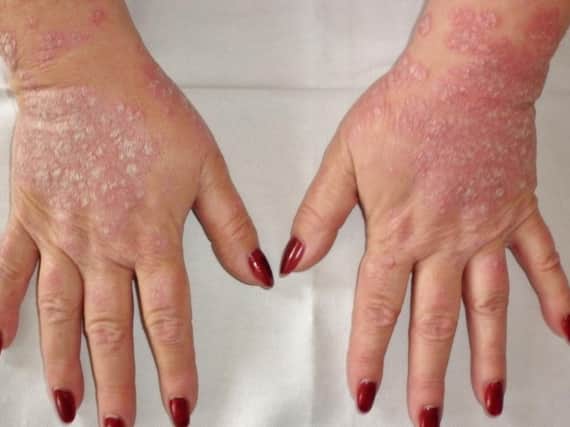Psoriasis is a common skin condition that causes red and sometimes painful irritation.