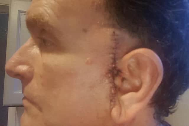 Adam's stage 3 melanoma was removed on October 23, and was confirmed as cancerous two weeks later. Now he has been given the all clear.