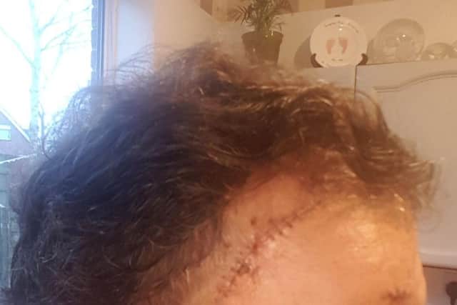 This picture shows Adam's stage 1 melanoma scar which was picked up at the same time as his stage 3 mole.