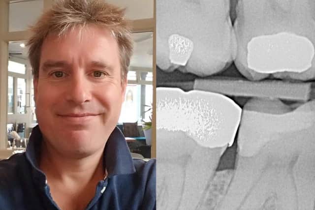 Andrew Fruish was beset with toothache for nearly a year after his tooth decay went undiagnosed.