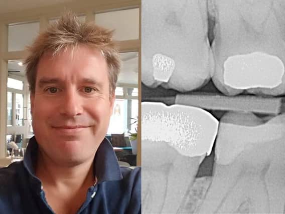 Andrew Fruish was beset with toothache for nearly a year after his tooth decay went undiagnosed.
