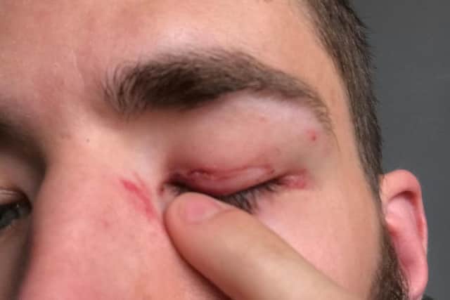 Mr Winkler sustained a hole to the eyelid after he was punched outside the Coop.