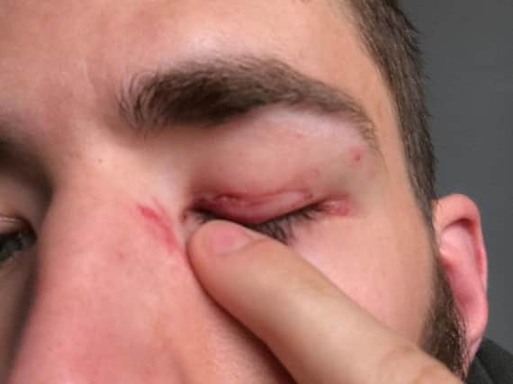 Mr Winkler sustained a hole to the eyelid after he was punched outside the Coop.
