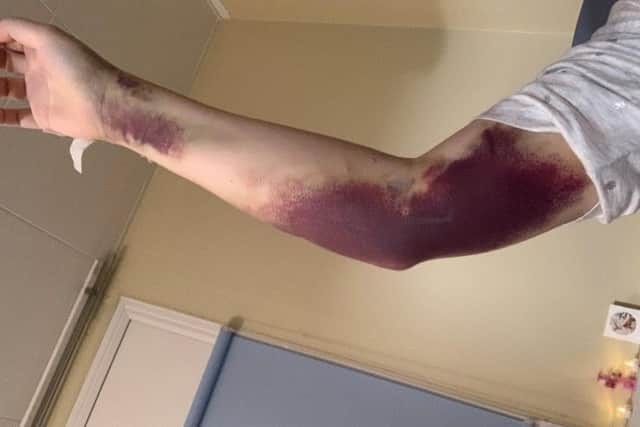 Hannah suffered bruising due to low platelets in her blood and an arterial
line being inserted.