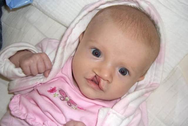 Baby Imogen pictured in 2006, was born with a cleft lip and palate which is agap or split in the upper lip or the roof of the mouth (palate) present from birth.