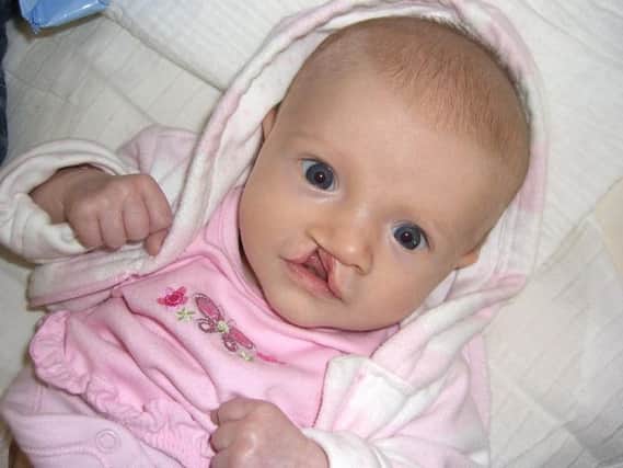 Baby Imogen pictured in 2006, was born with a cleft lip and palate which is agap or split in the upper lip or the roof of the mouth (palate) present from birth.