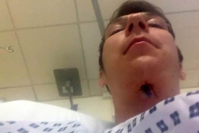 Jake's surgery scars. Picture: SWNS