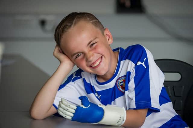 William Joyner with his new prosthetic hand