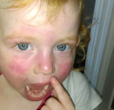 Child's skin after using the wipes. PHOTO: SWNS