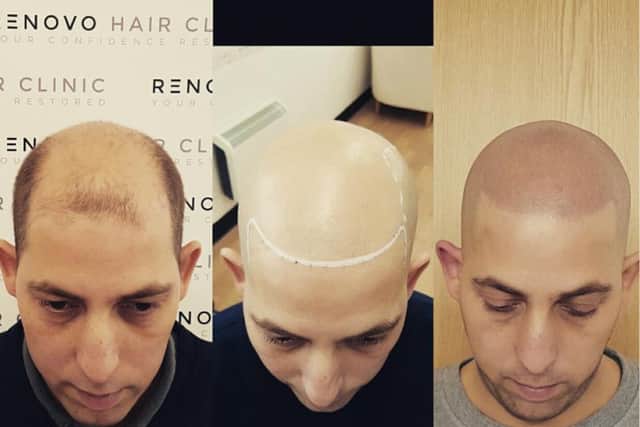A medical tattoo clinic opens in Northampton to help patients disguise hair loss