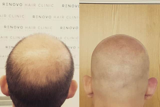 Before and after pictures of the work carried out at Renovo Hair Clinic