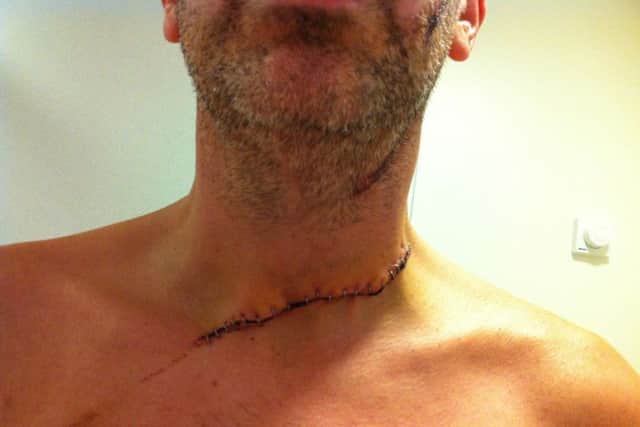 Simon's throat after the incident