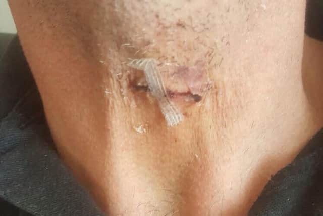 Doctors had to glue the wound to Tony's neck back together. Thankfully the attackers missed his windpipe and main arteries.