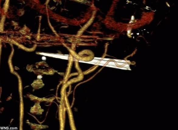 The swordfish's bill narrowly missed the major arteries in Mr Pope's neck
