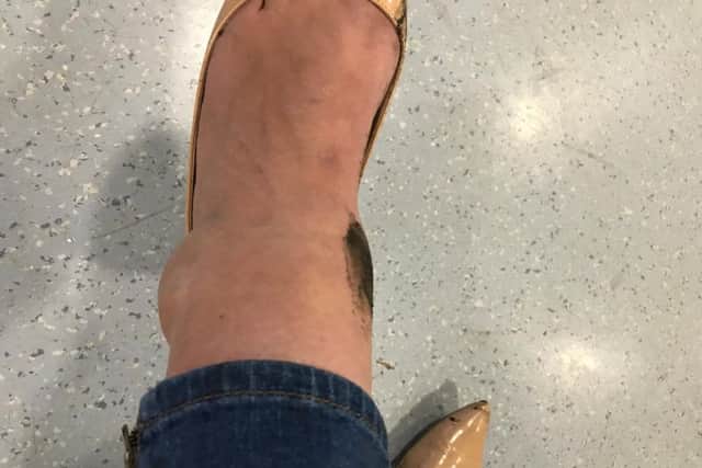 Her injured ankle.